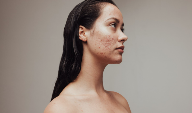 acne Acne treatment Charlotte, NC