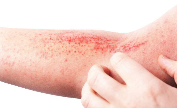 eczema Eczema