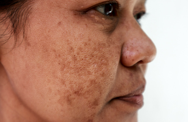 melasma Melasma