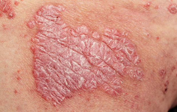 psoriasis Psoriasis