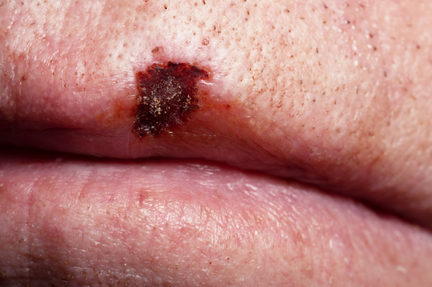 skin-cancers skin cancers